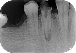 Zęba nie ma. Na razie... :)